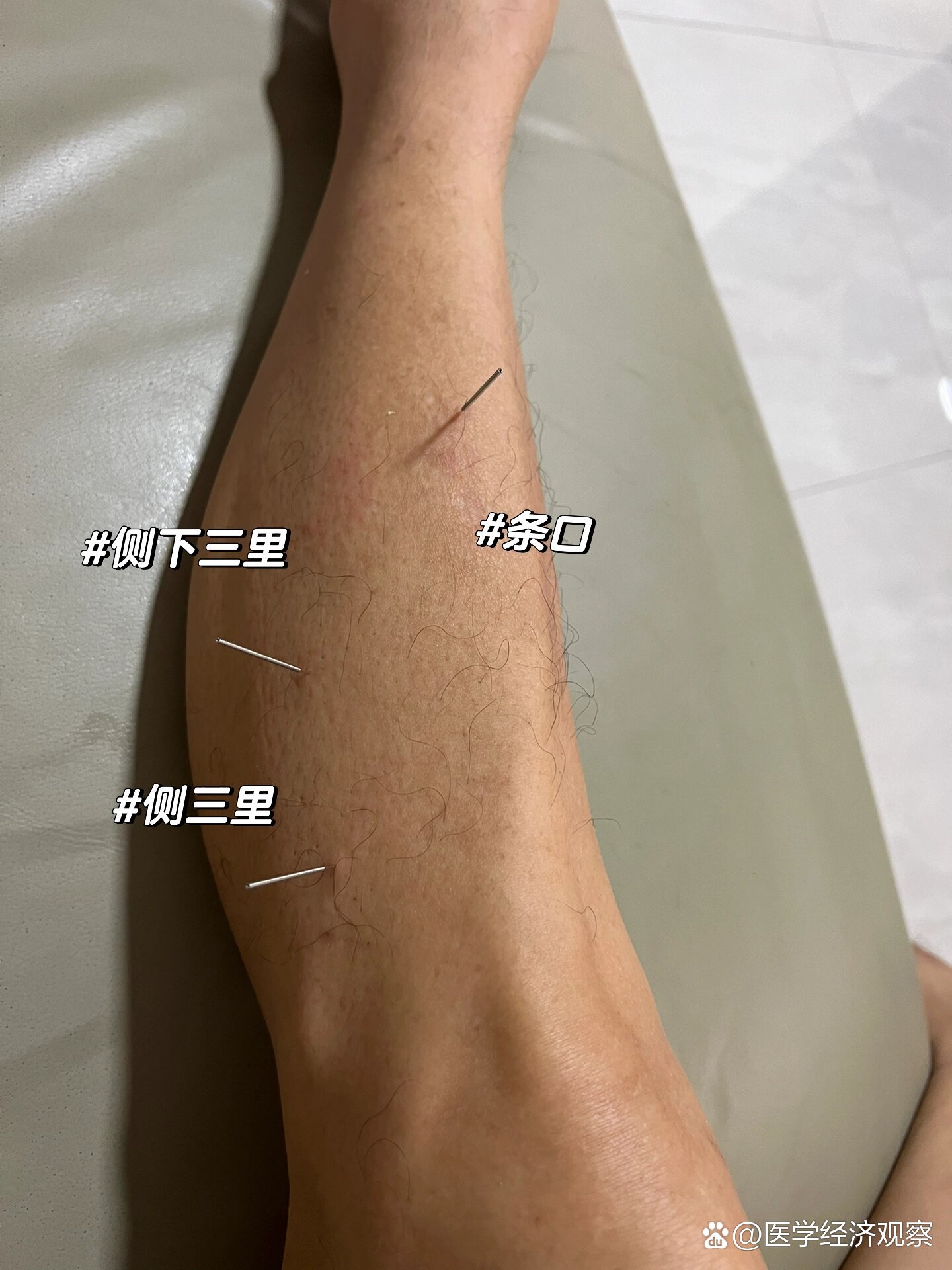 董氏和传统穴-侧三里,侧下三里,阳池,养老