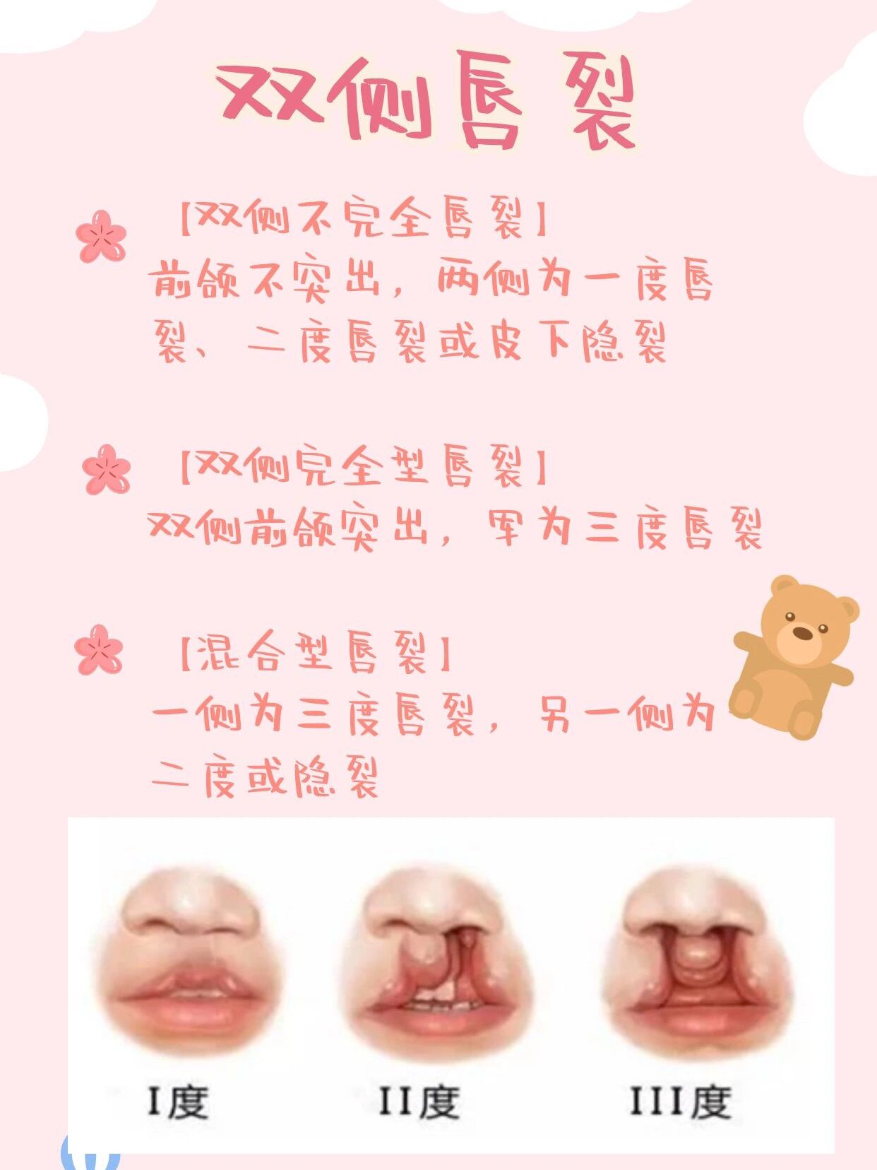 唇裂基本认知:唇腭裂按严重程度分类型