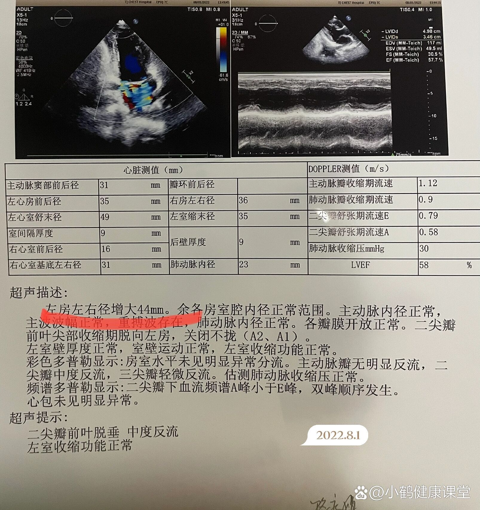 二尖瓣前叶前移图片