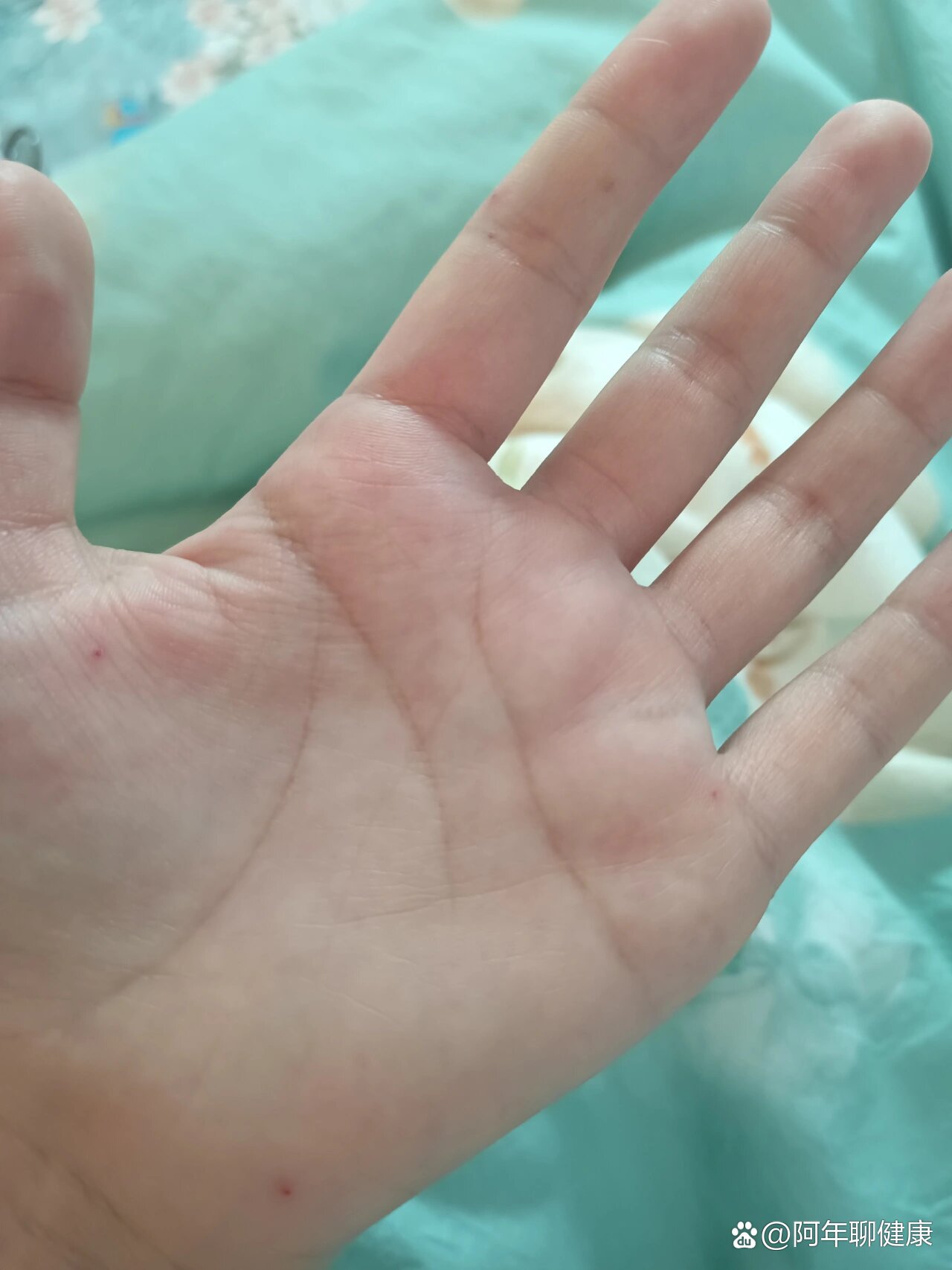 手掌上长了很多个小红点,有的变大变红了