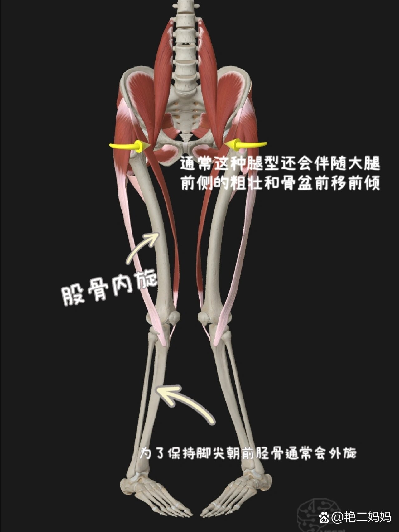 和臀大肌无力无法拉动股骨外旋股骨自然形成内旋