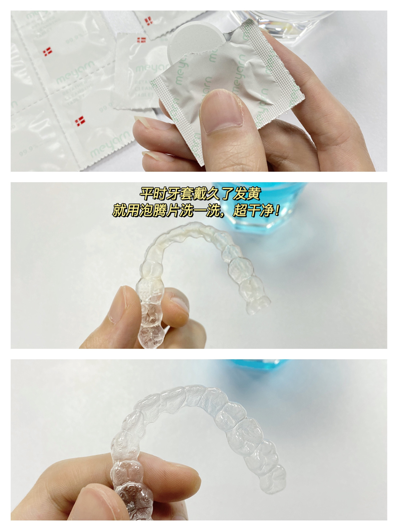矫正懒的最爱"舌侧保持器"优点和缺点