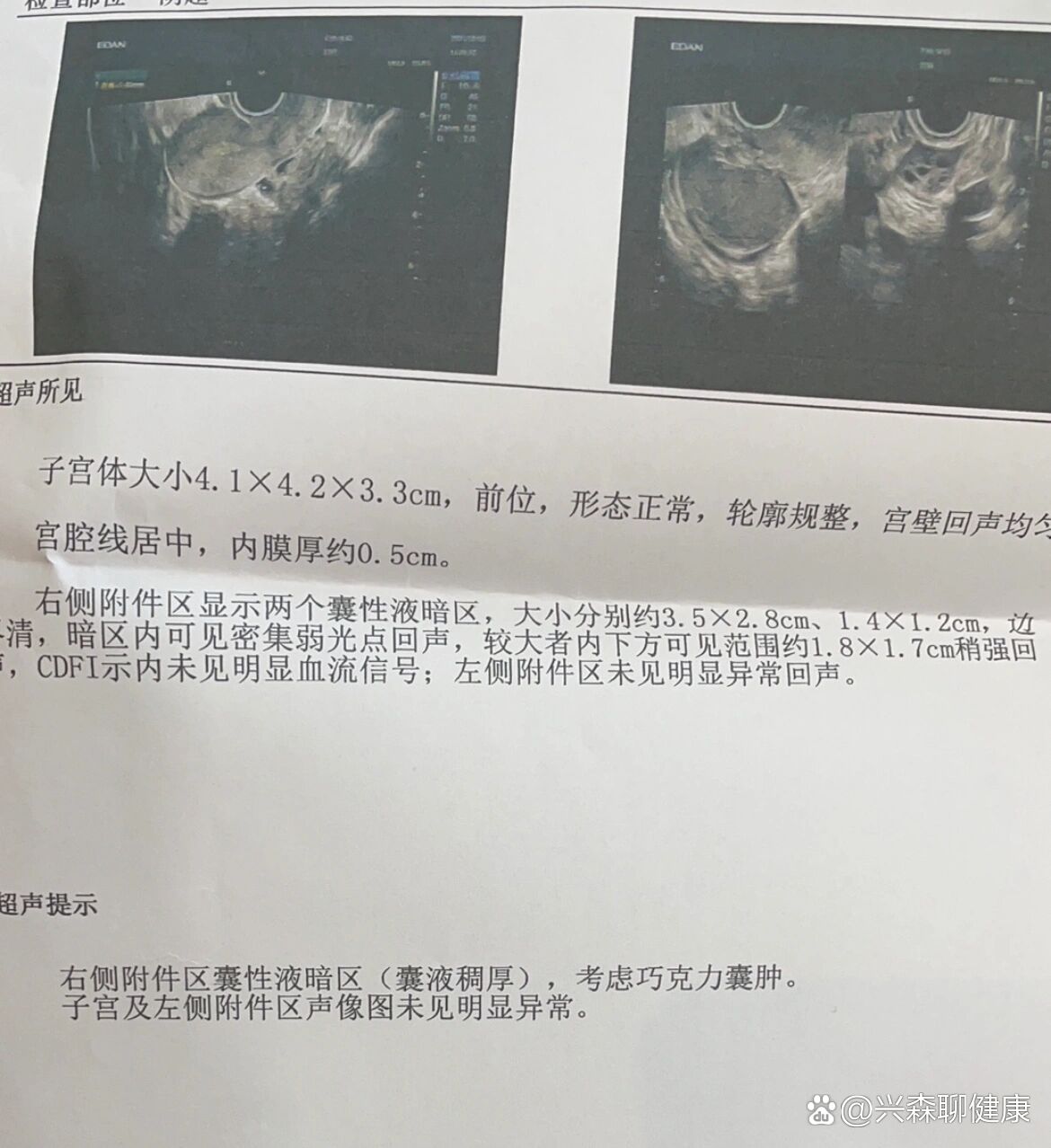 巧克力囊肿