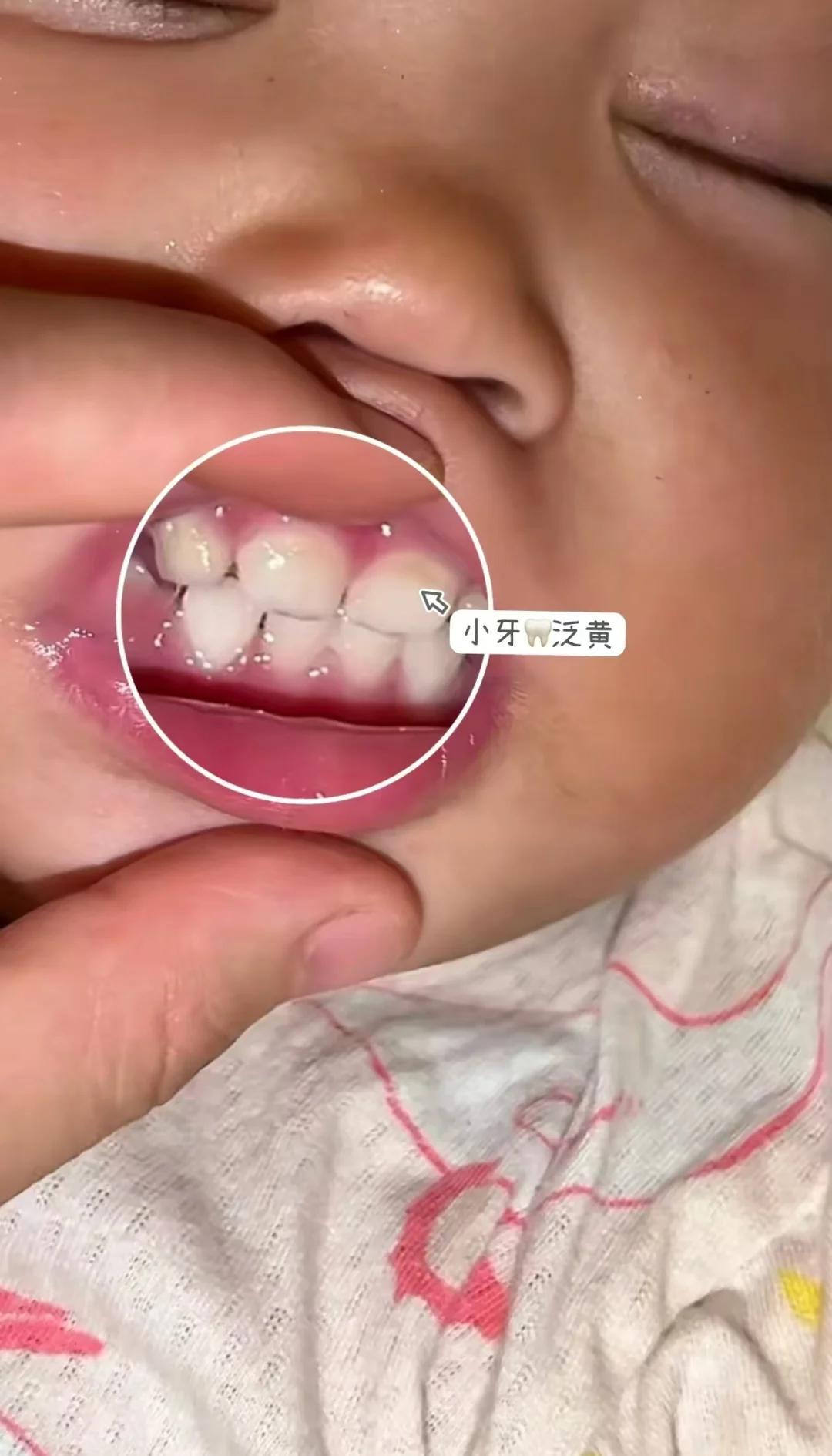 宝宝牙齿脱矿自救指南！