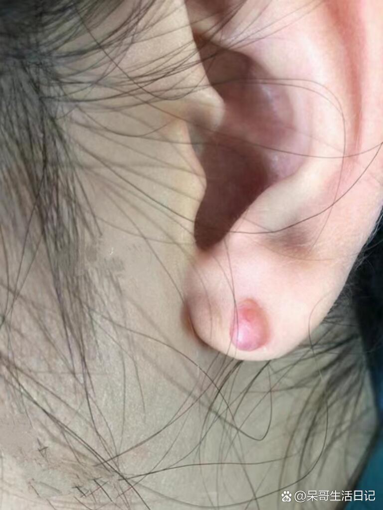 关于我耳朵后面长了个硬包
