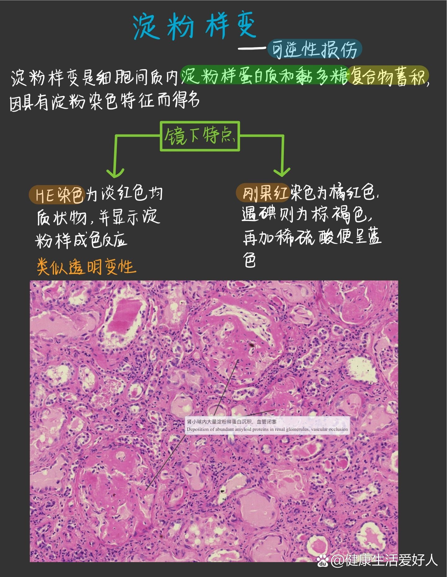 病理学‖适应与损伤‖淀粉样变