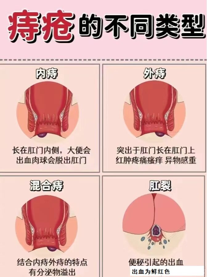 不同痔疮的图片 初期图片