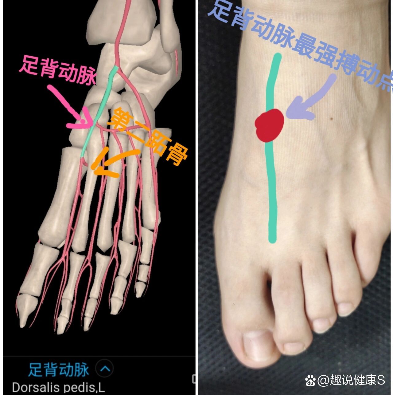 足底动脉解剖图图片