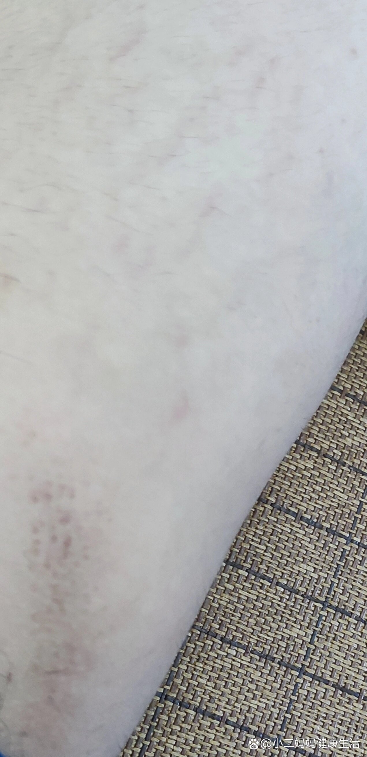 大腿内侧长了黑点是啥情况