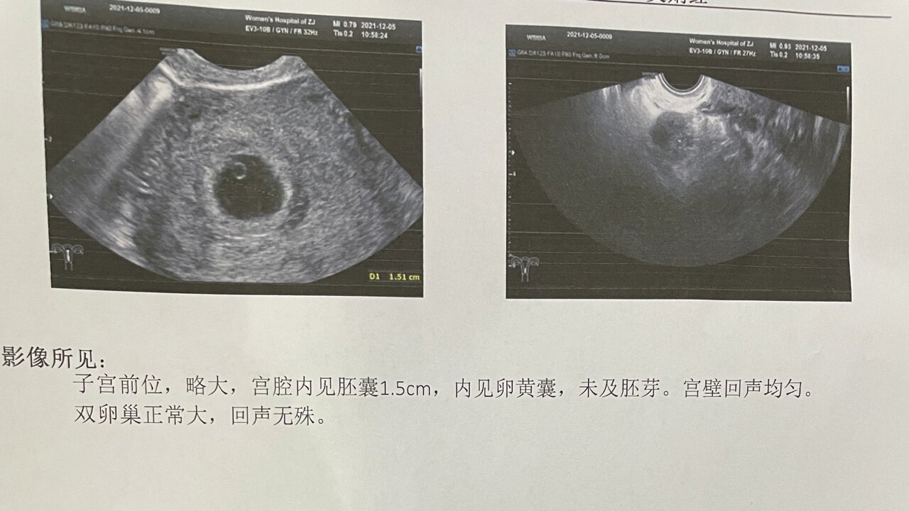 孕早期各种担心,今天看到圆滚滚的孕囊啦从发现怀孕就天天担心