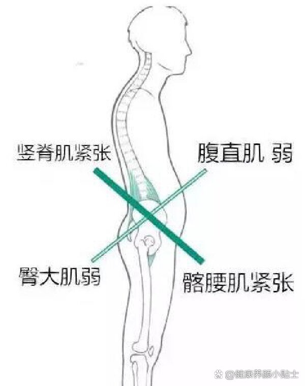 下交叉综合症矫正图解图片