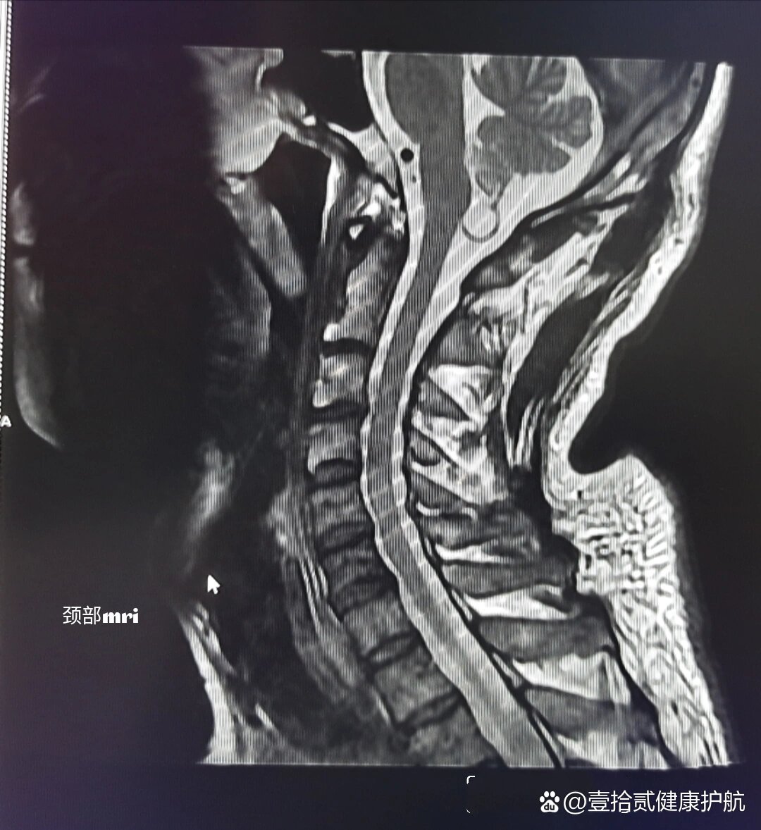一个标准的颈椎间盘突出的磁共振图像