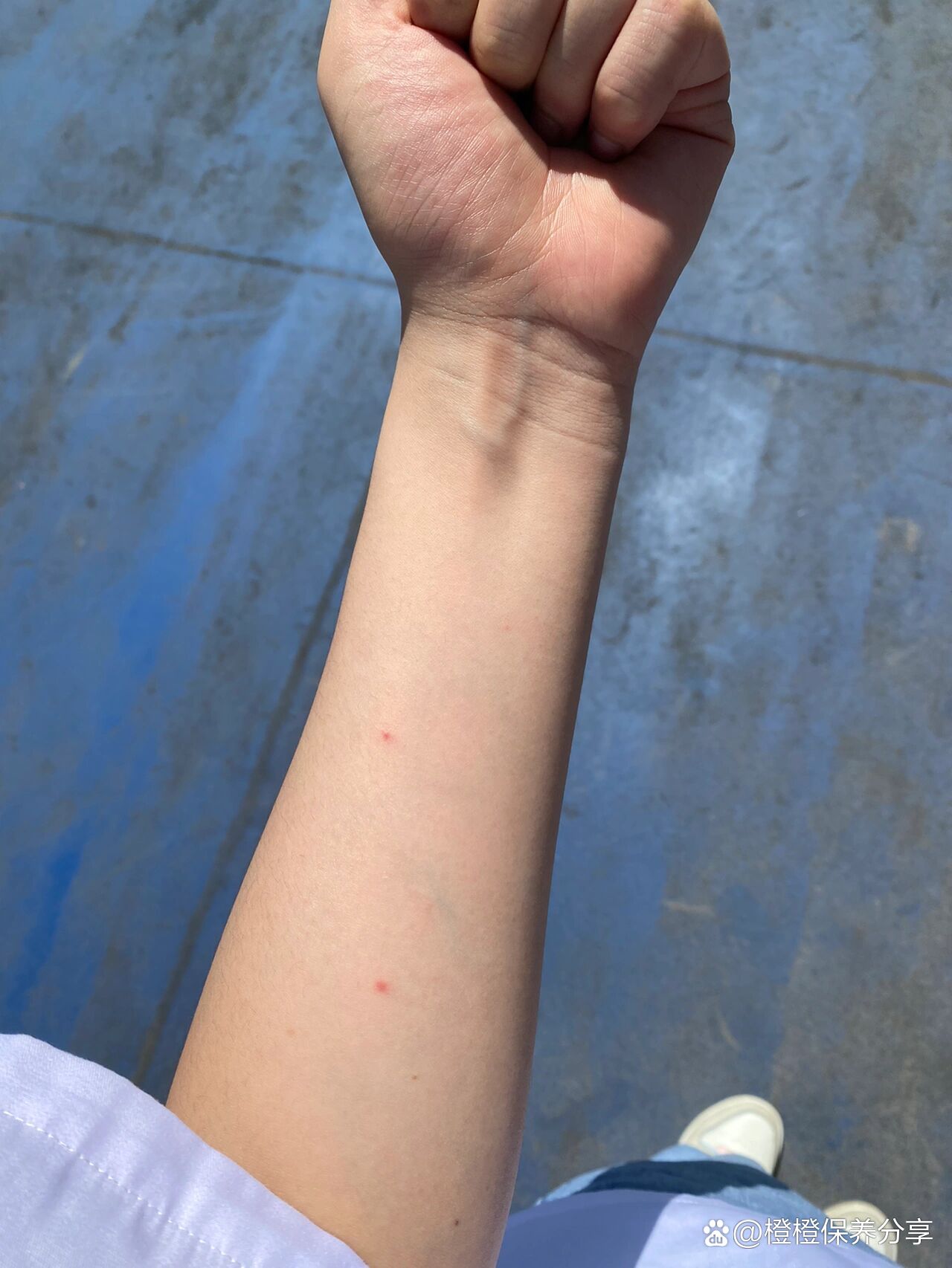 蚊子咬的这种红点怎么消啊?