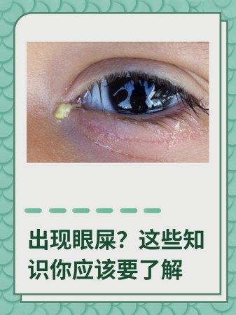 出现眼屎?这些知识你应该要了解