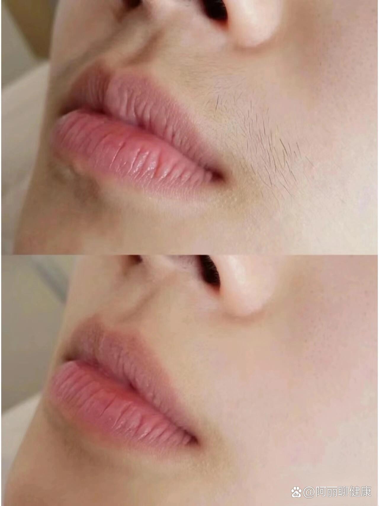 唇部脱毛对比图精致不是一点点整个肤色都亮