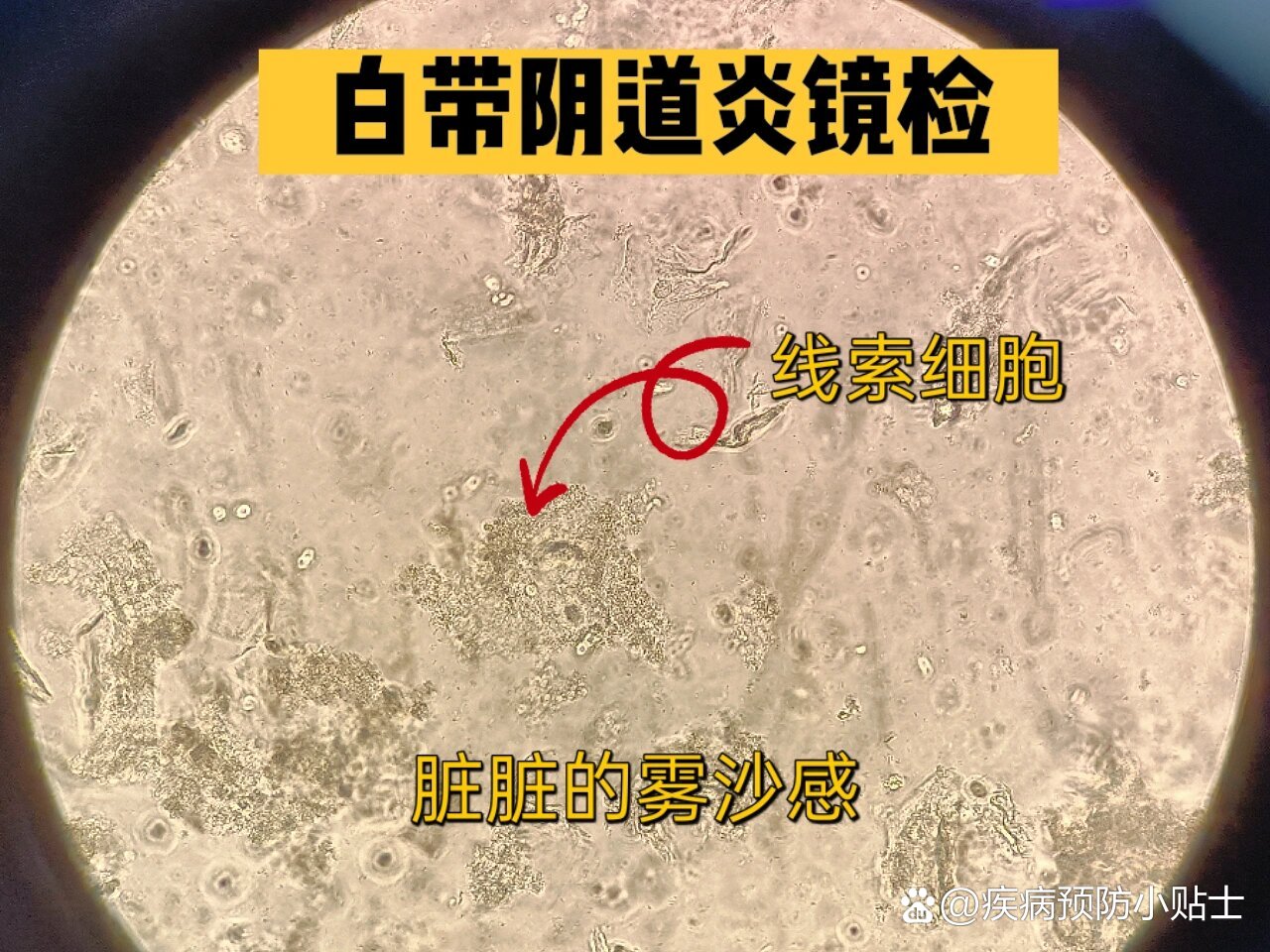 [白带镜检]检线索细胞是什么?