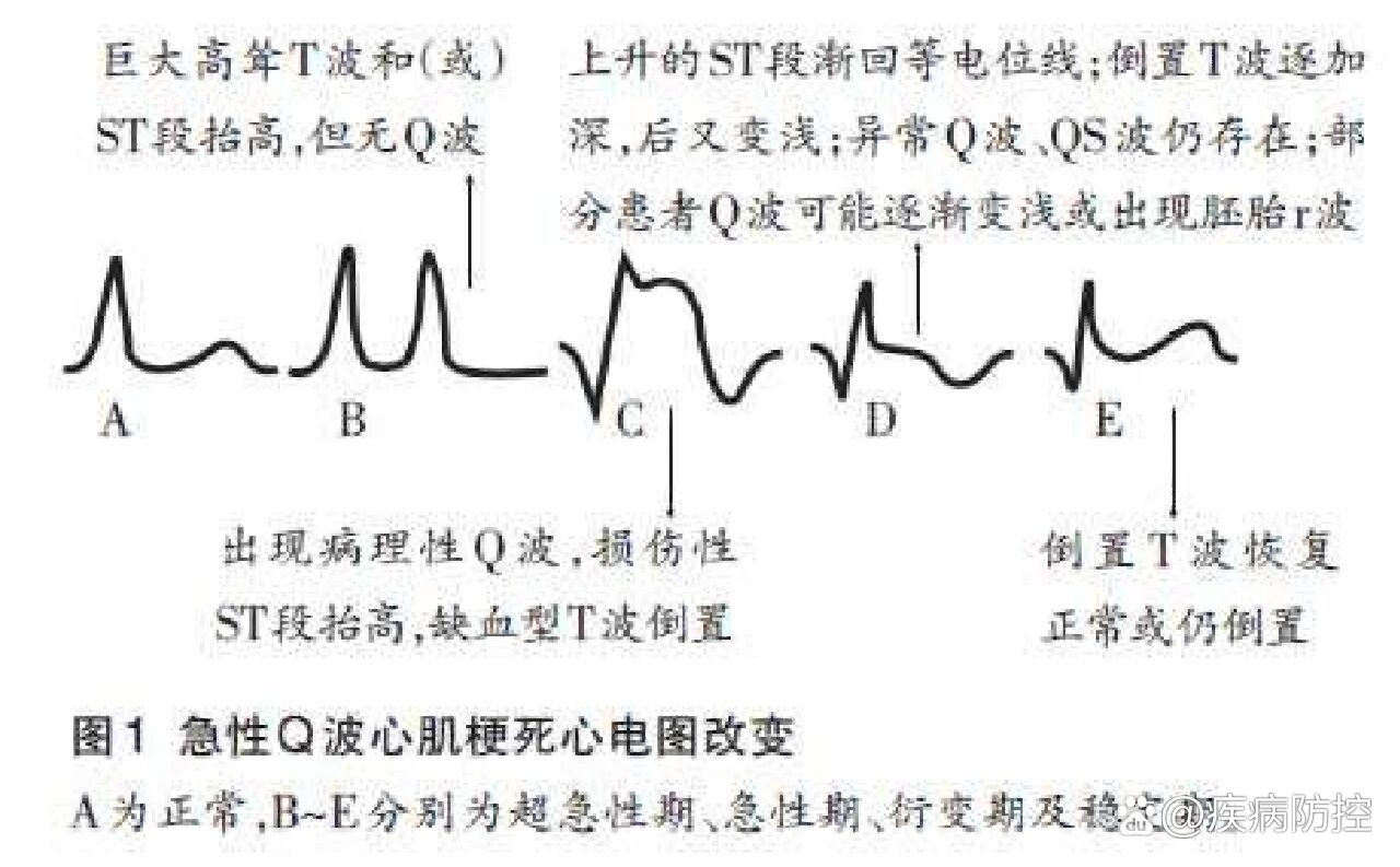 急性心肌梗死心电图波形及演变