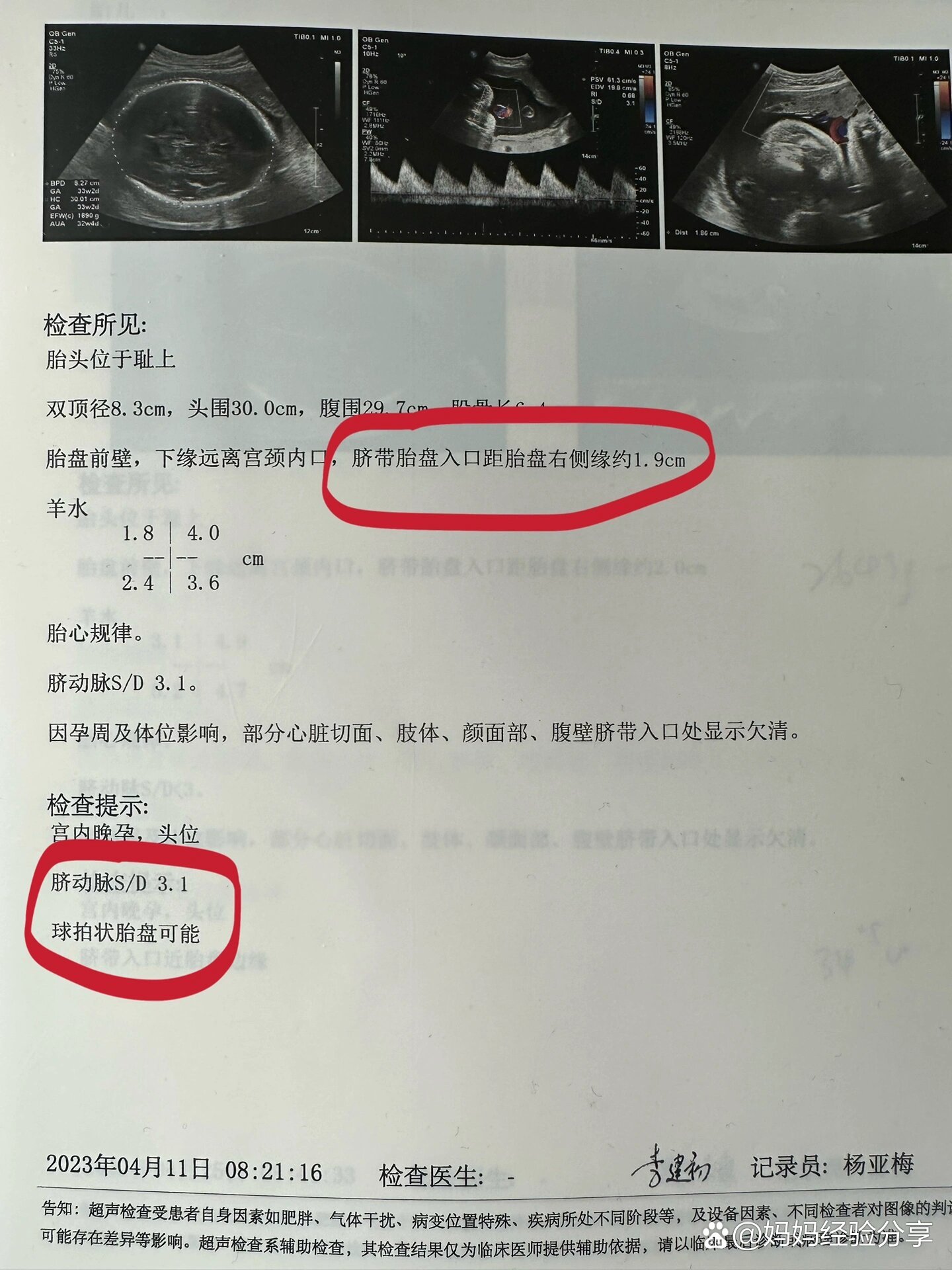 球拍状胎盘vs帆状胎盘vs正常胎盘