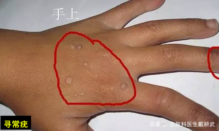 HPV感染后的疣都长什么样