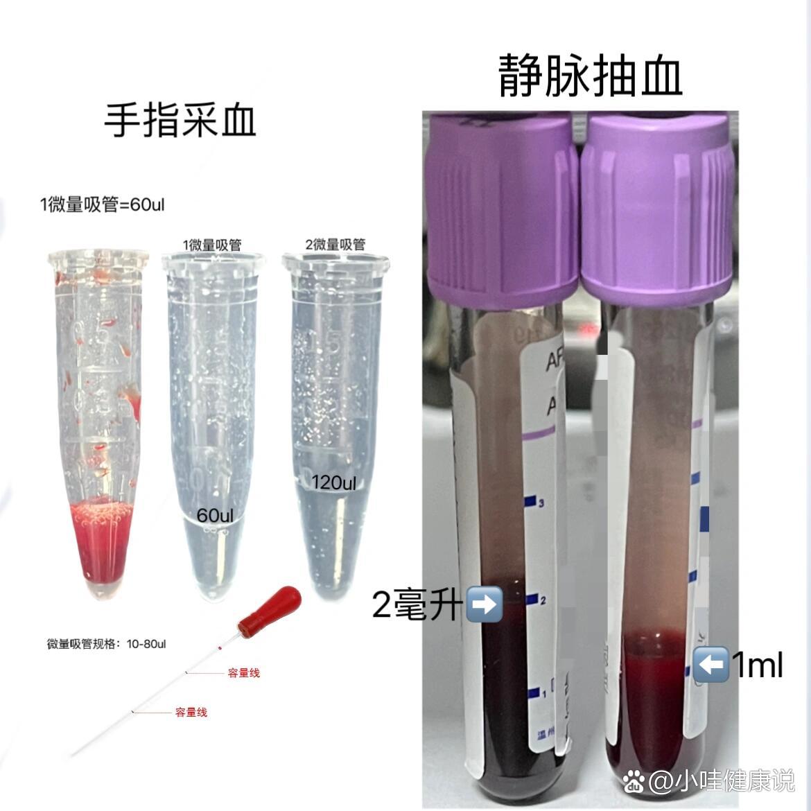 儿童静脉采血常用部位图片