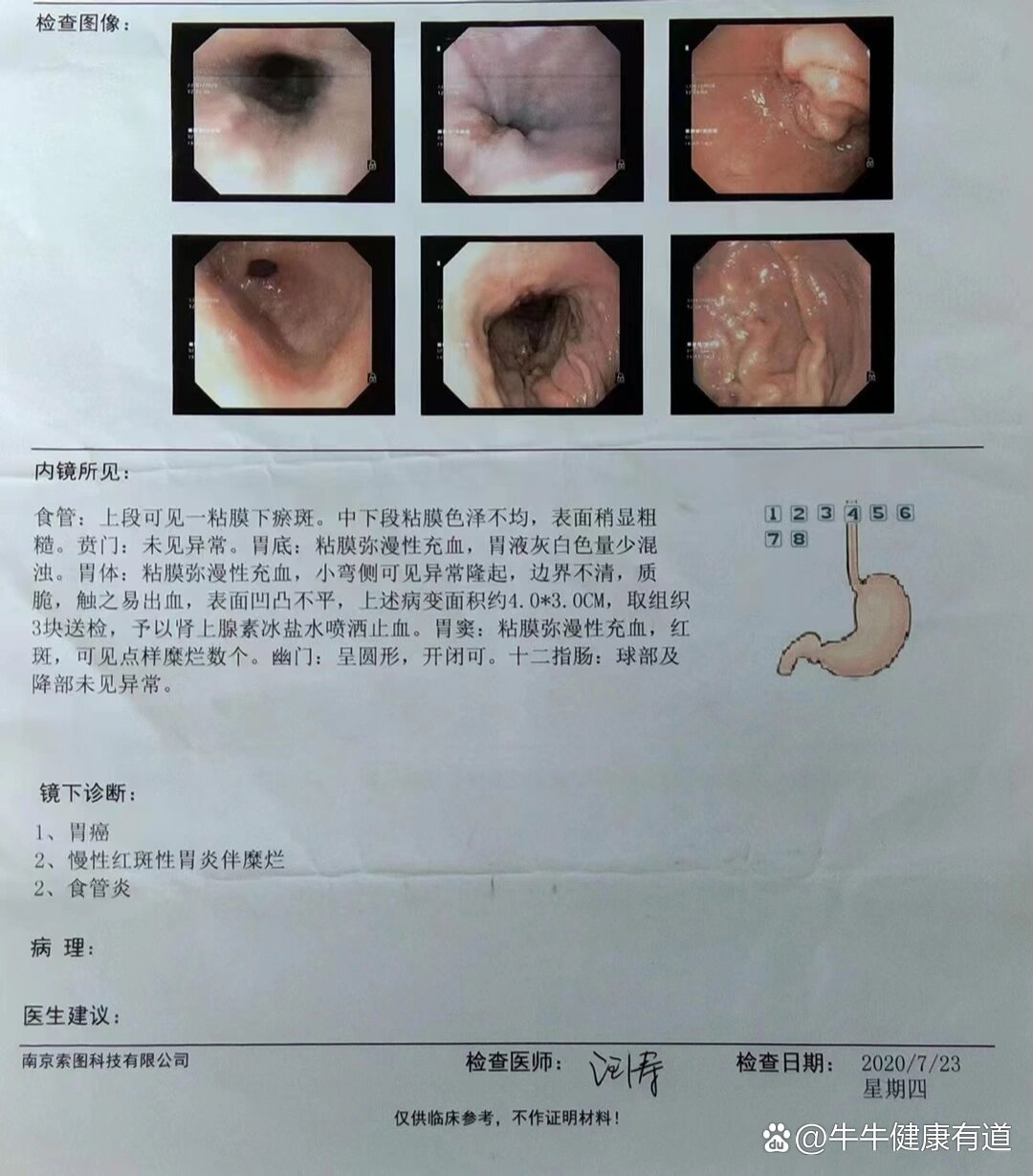 ??br胃癌在我国发病率居高不下每年新发病例在40