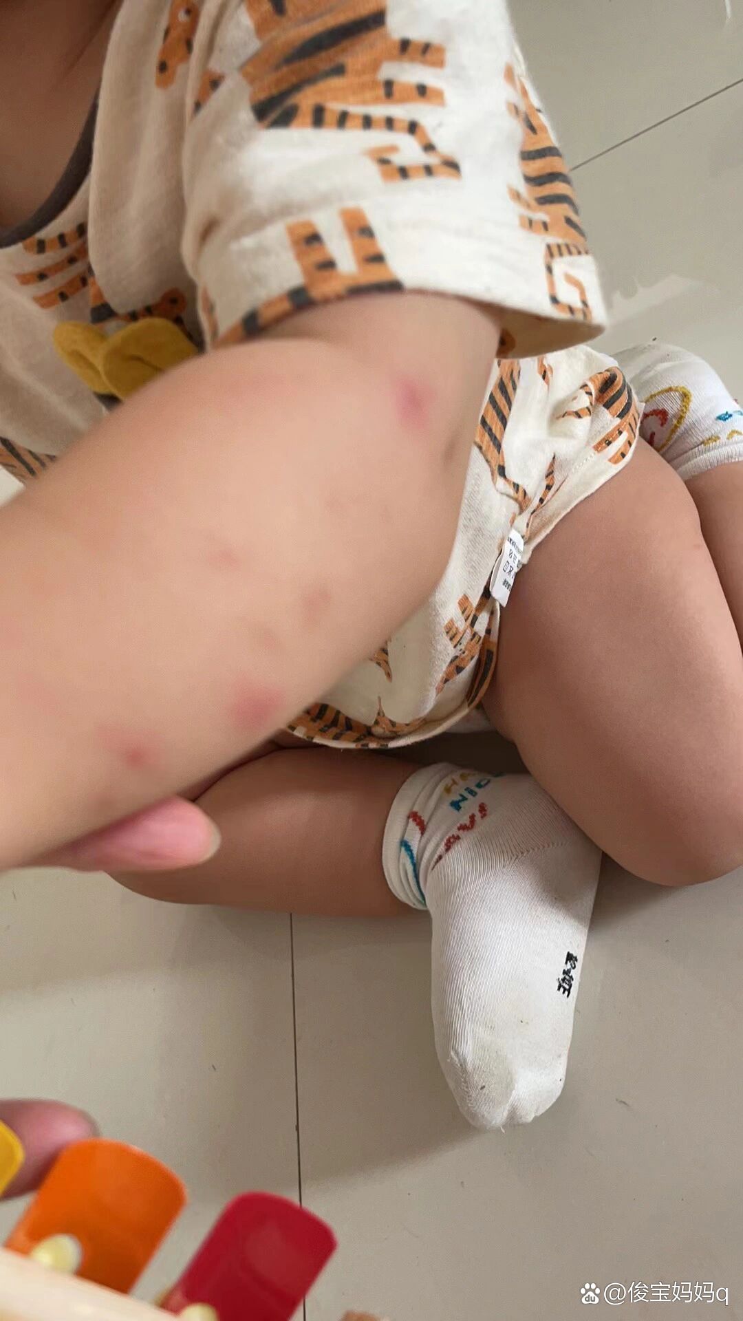 一周岁宝宝身上爆红点