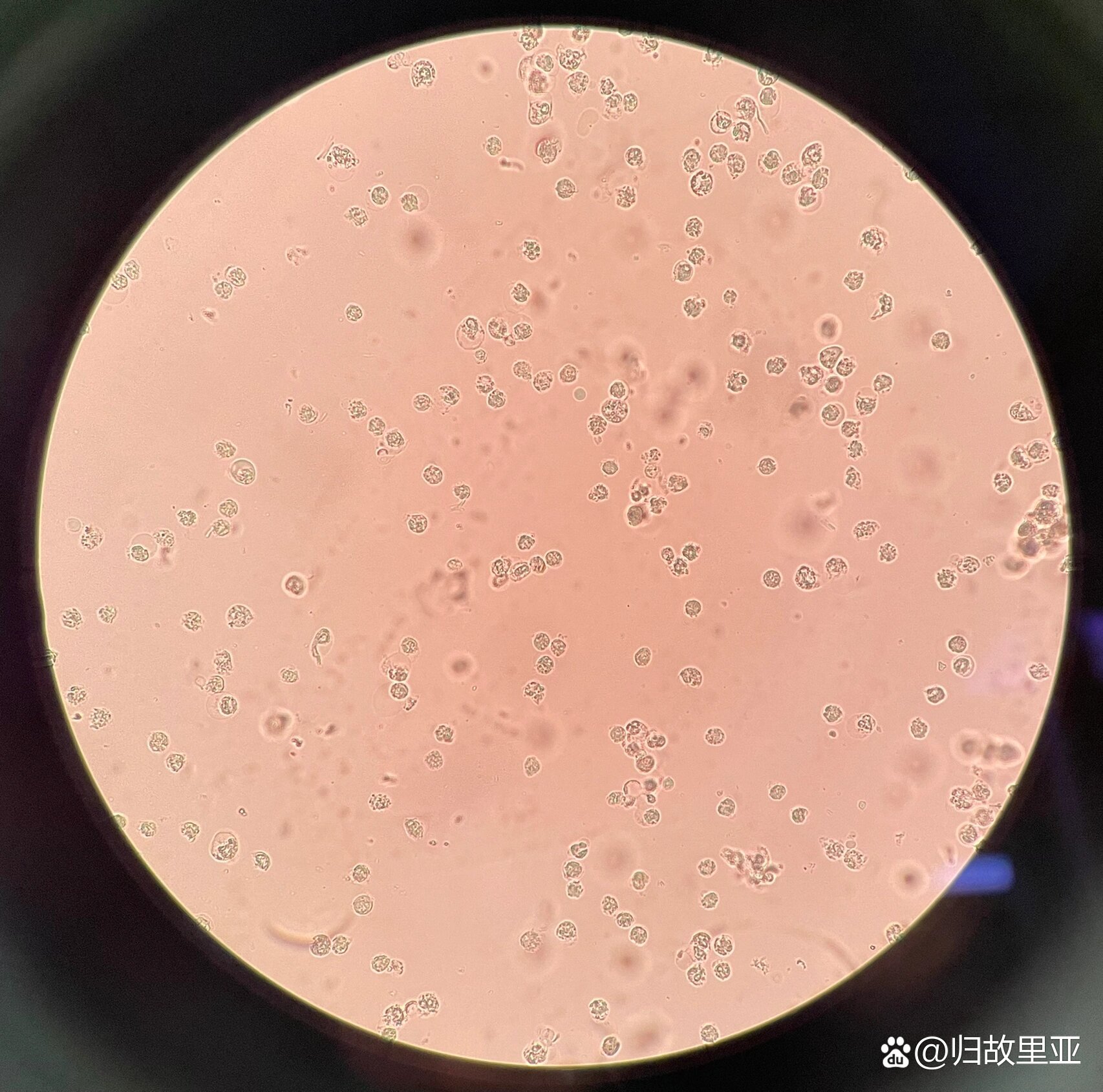  br>尿中白细胞多为炎症感染时出现的中性粒细胞.