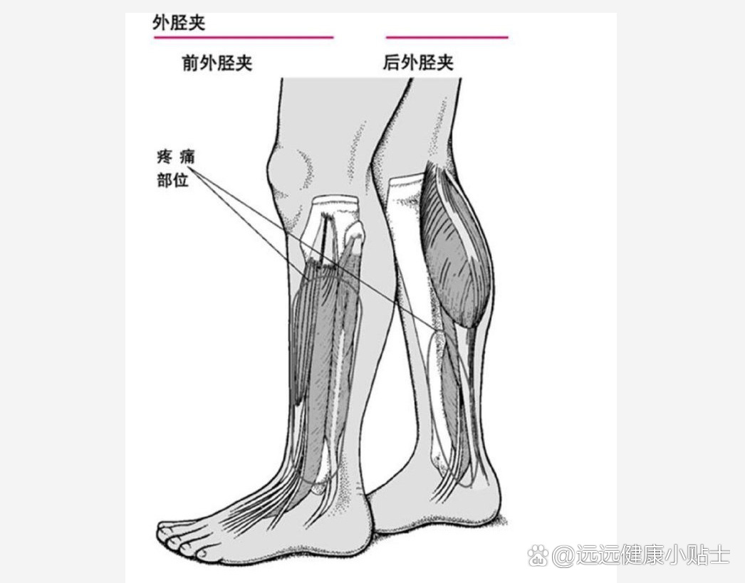 小腿外侧疼痛严重怎么办