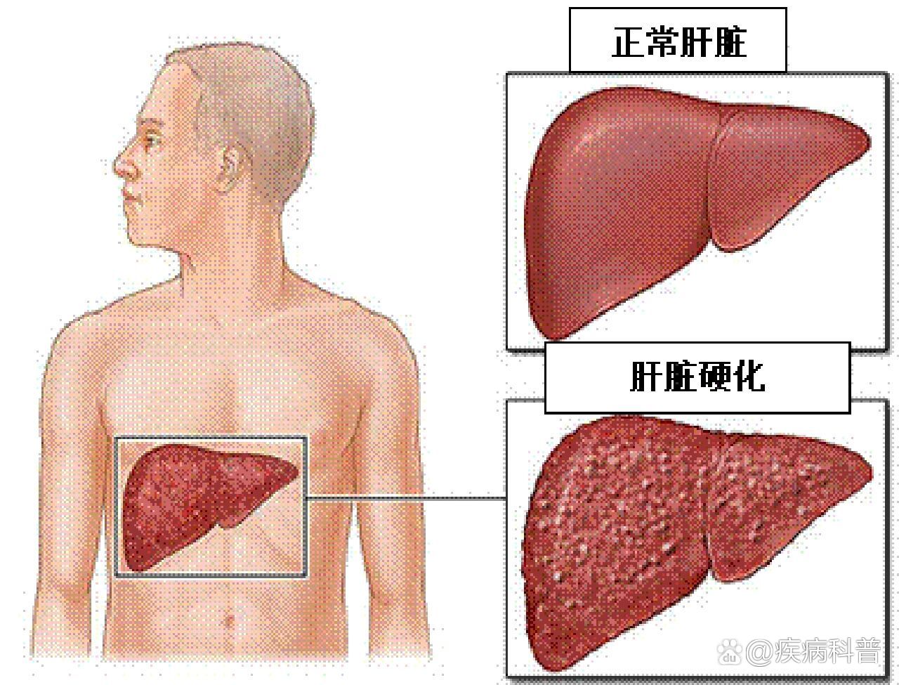 肝硬化腹水患者能活多久?
