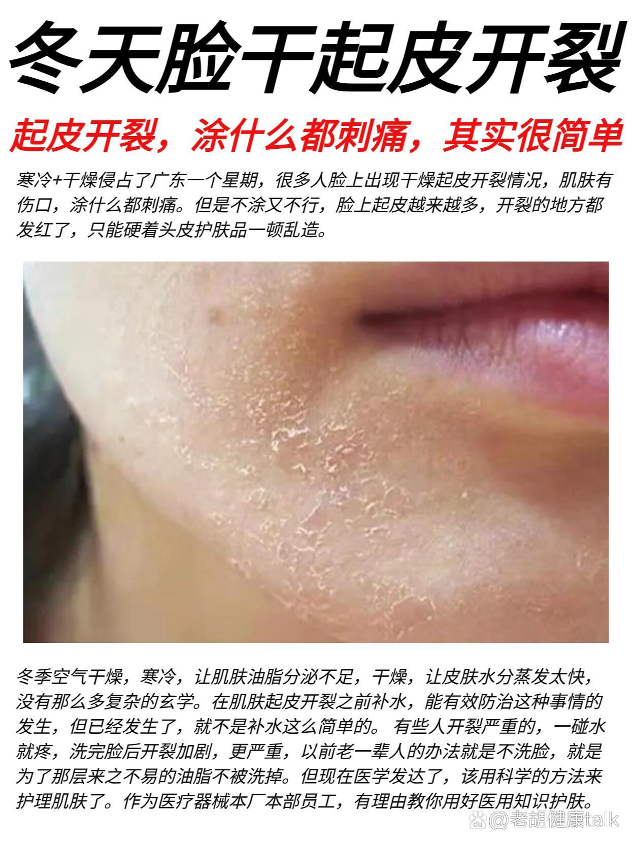 冬天脸干起皮开裂,做错才可怕