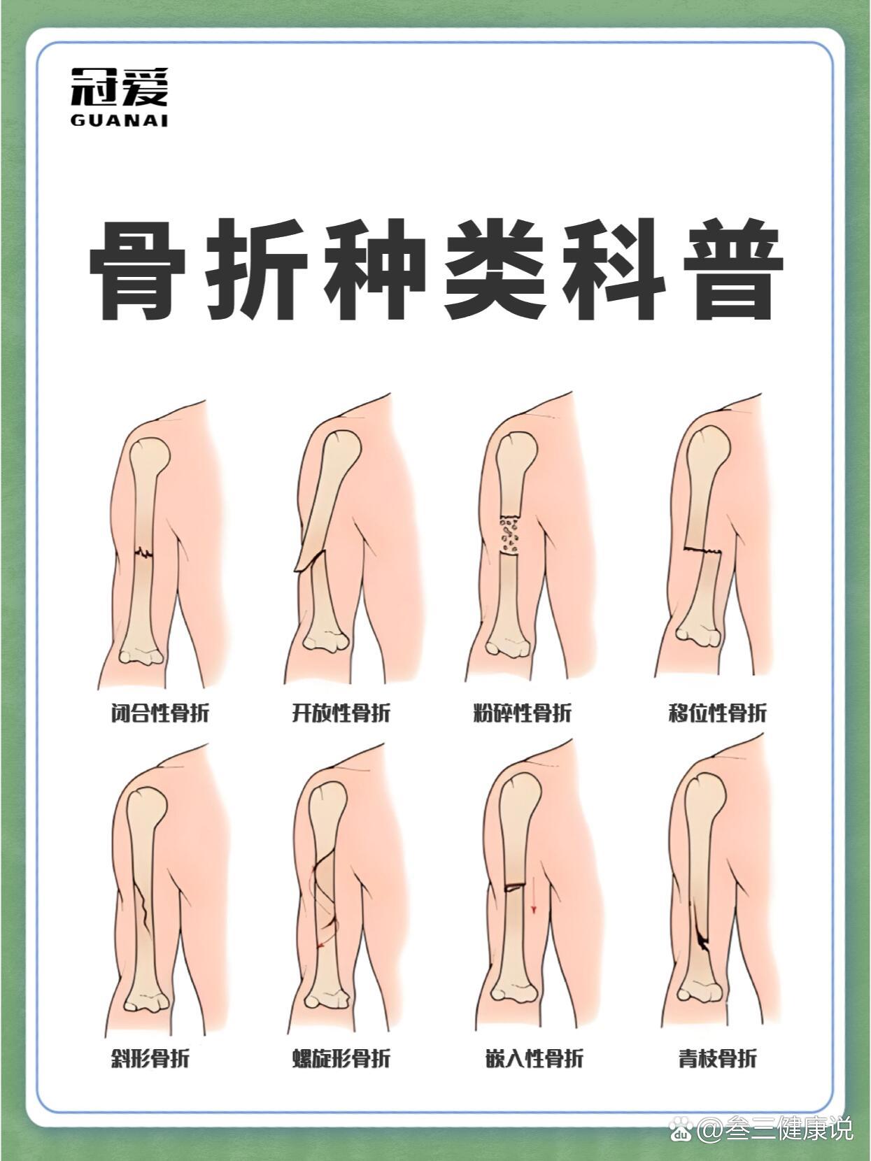 95认识骨折种类&不同部位骨折的恢复时间
