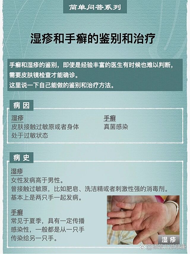 湿疹和手癣的鉴别和治疗