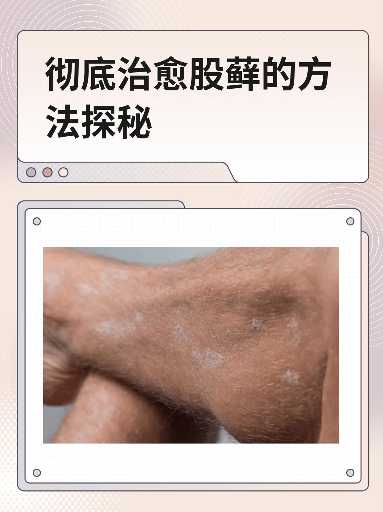 大腿根股癣 治疗方法图片