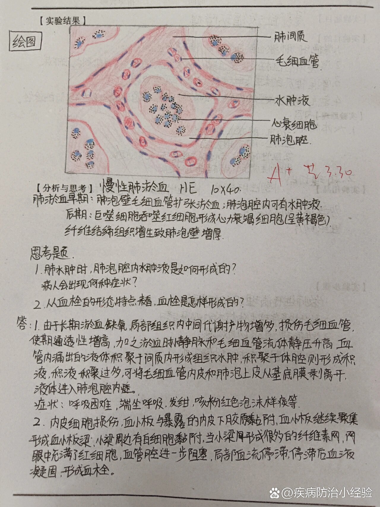 慢性肺淤血切片手绘图图片