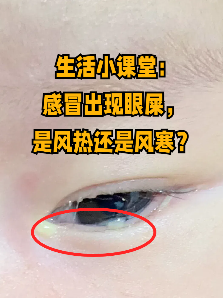 生活小课堂:感冒出现眼屎,是风热还是风寒?