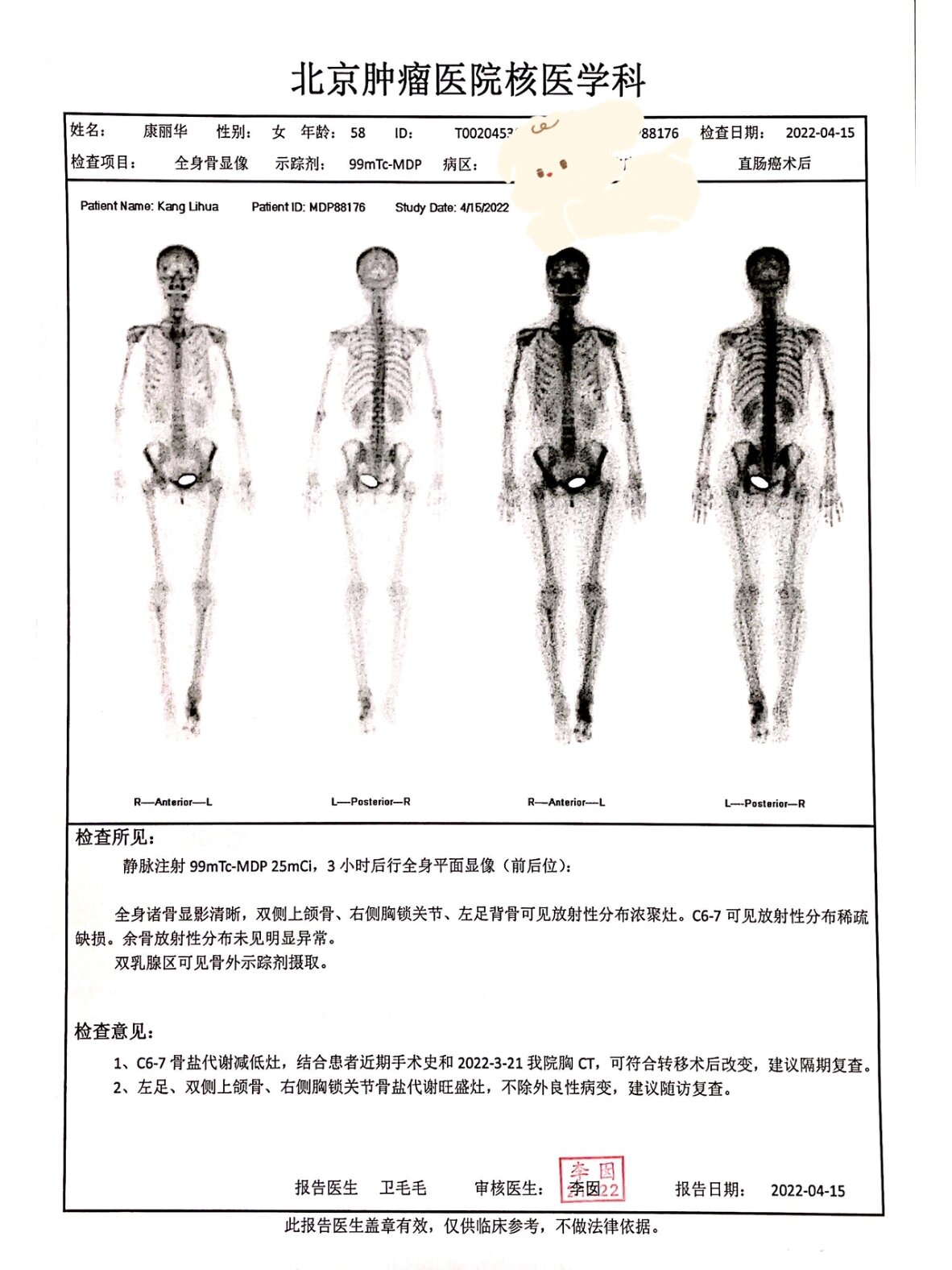 全身骨显像报告解读图片