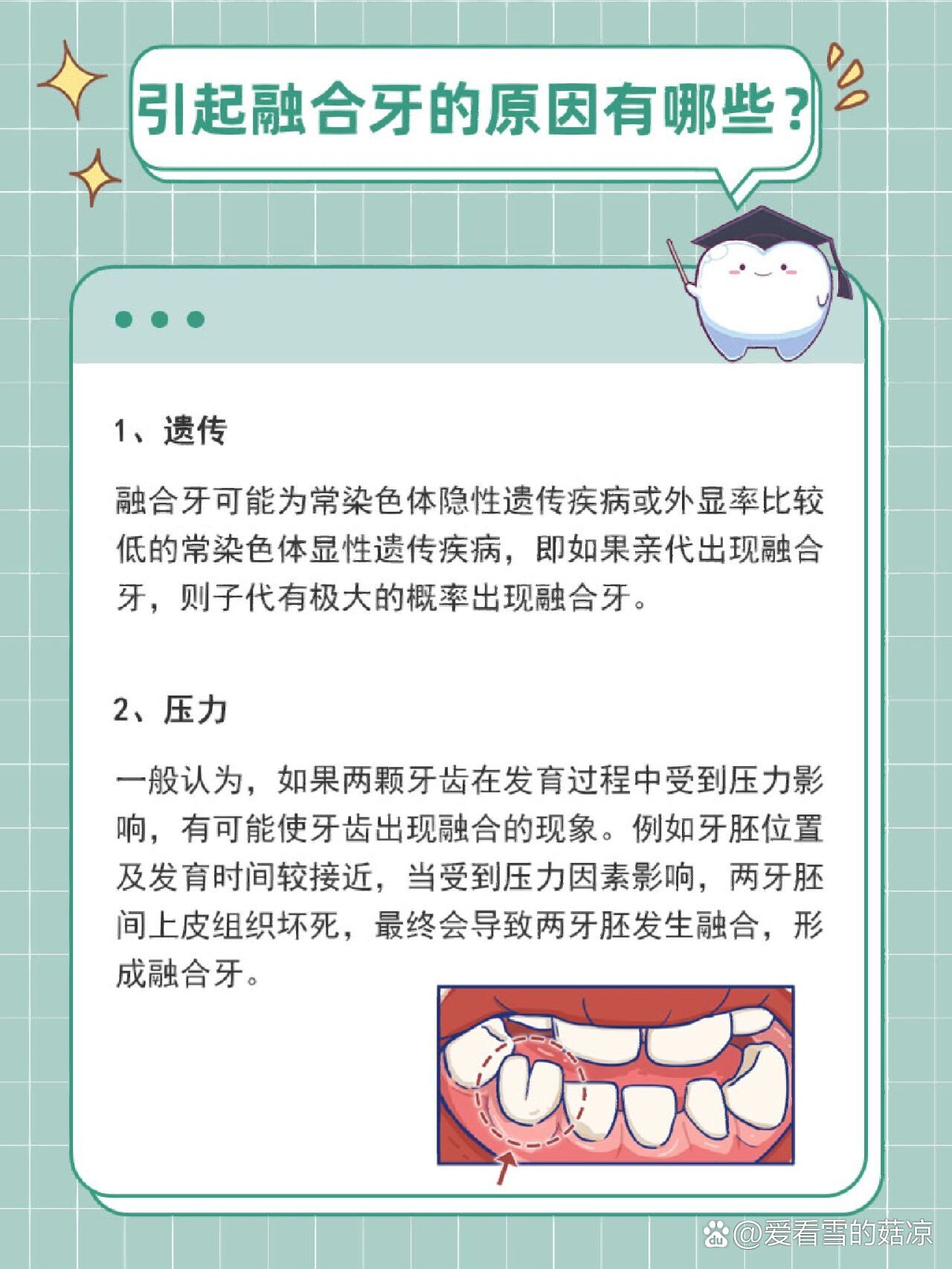 引起融合牙的原因有哪些71