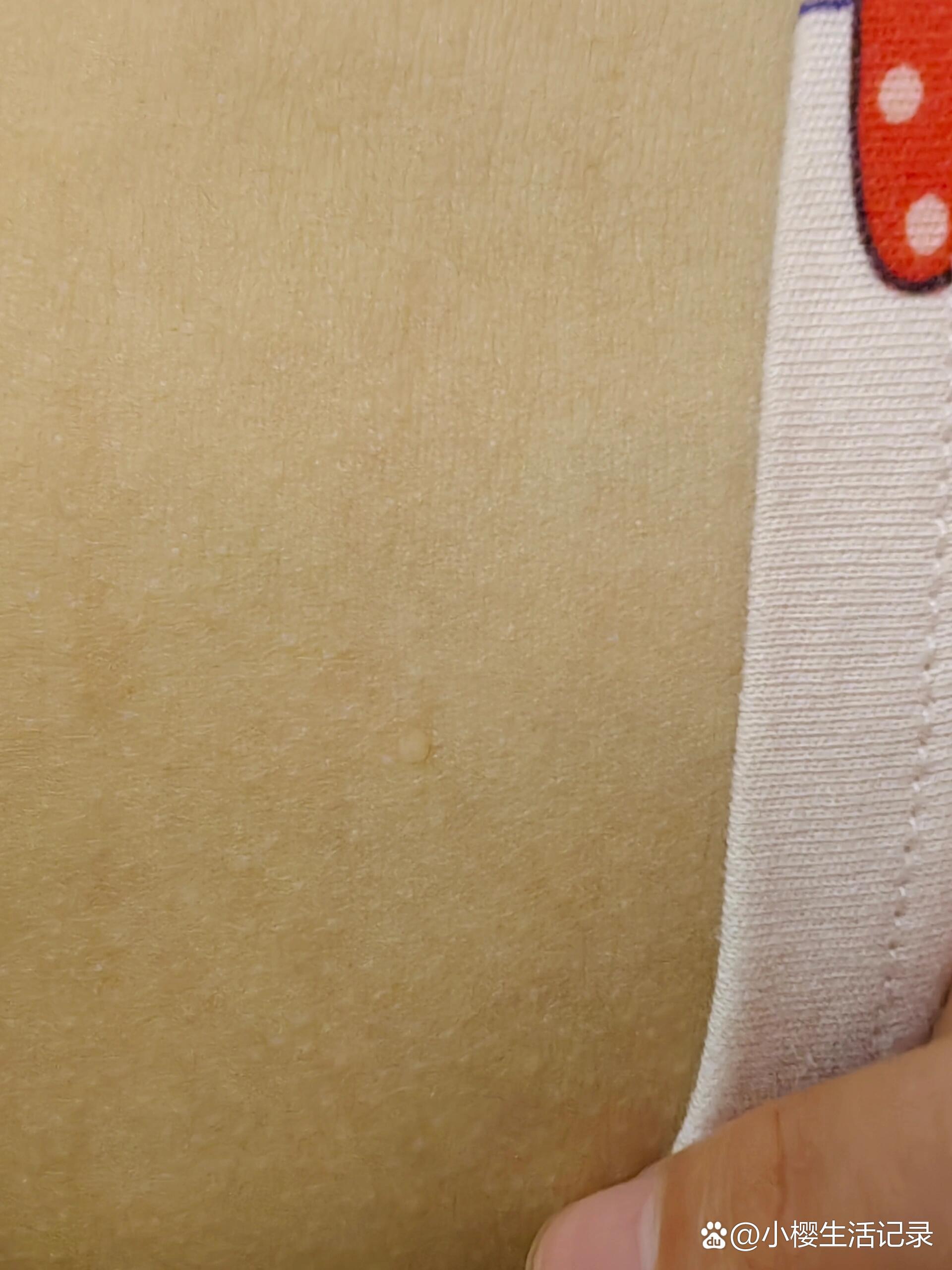 孩子肚皮和腰部各有一个白色小肉凸起