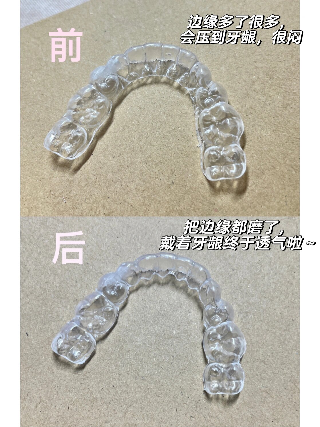 透明保持器边缘自己打磨,牙龈不闷了