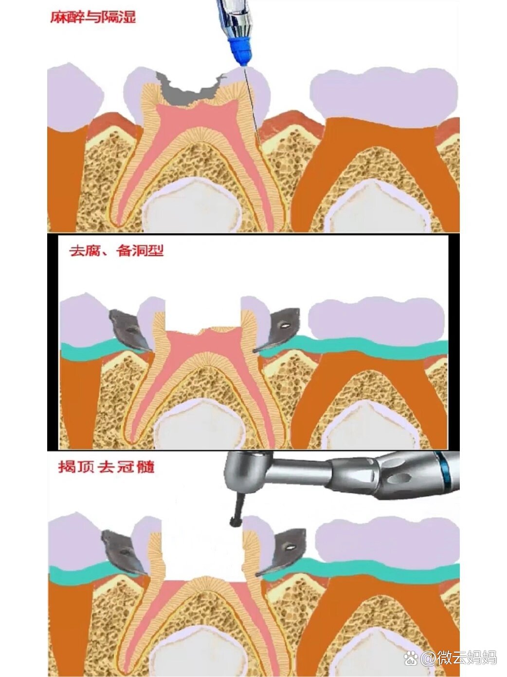 根尖诱导成形术步骤图片