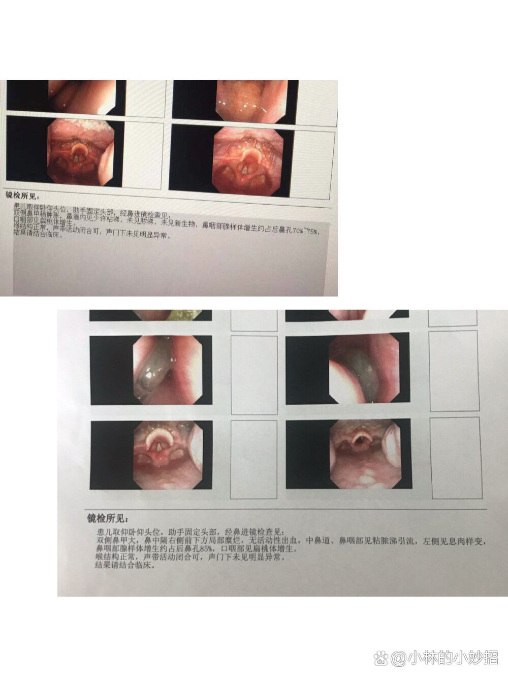 我带六岁的俊古去南科大医院儿童耳鼻喉专科进行了腺样体 鼻息肉