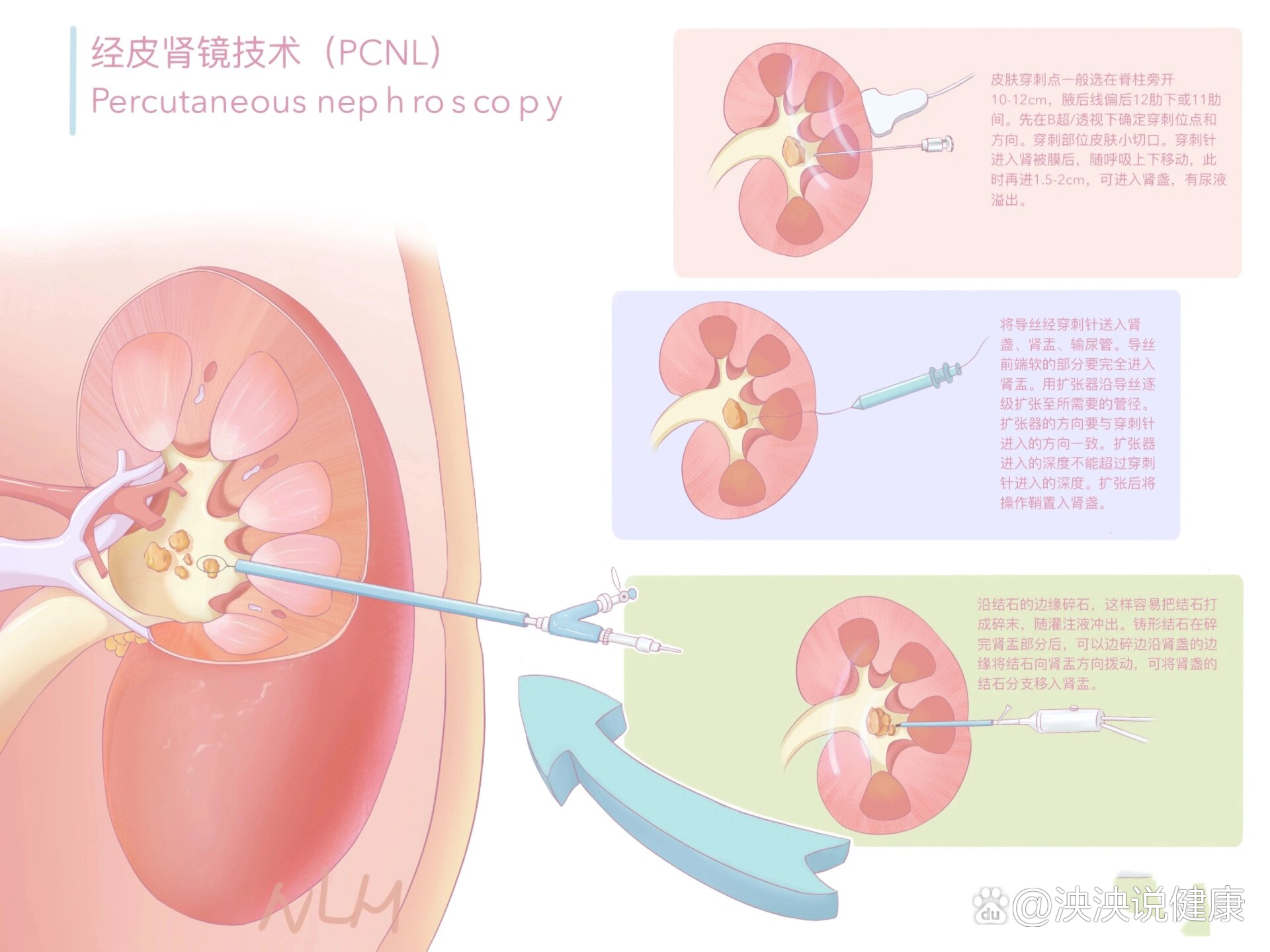 经皮肾镜技术复杂性肾结石是指直径累积大于 2