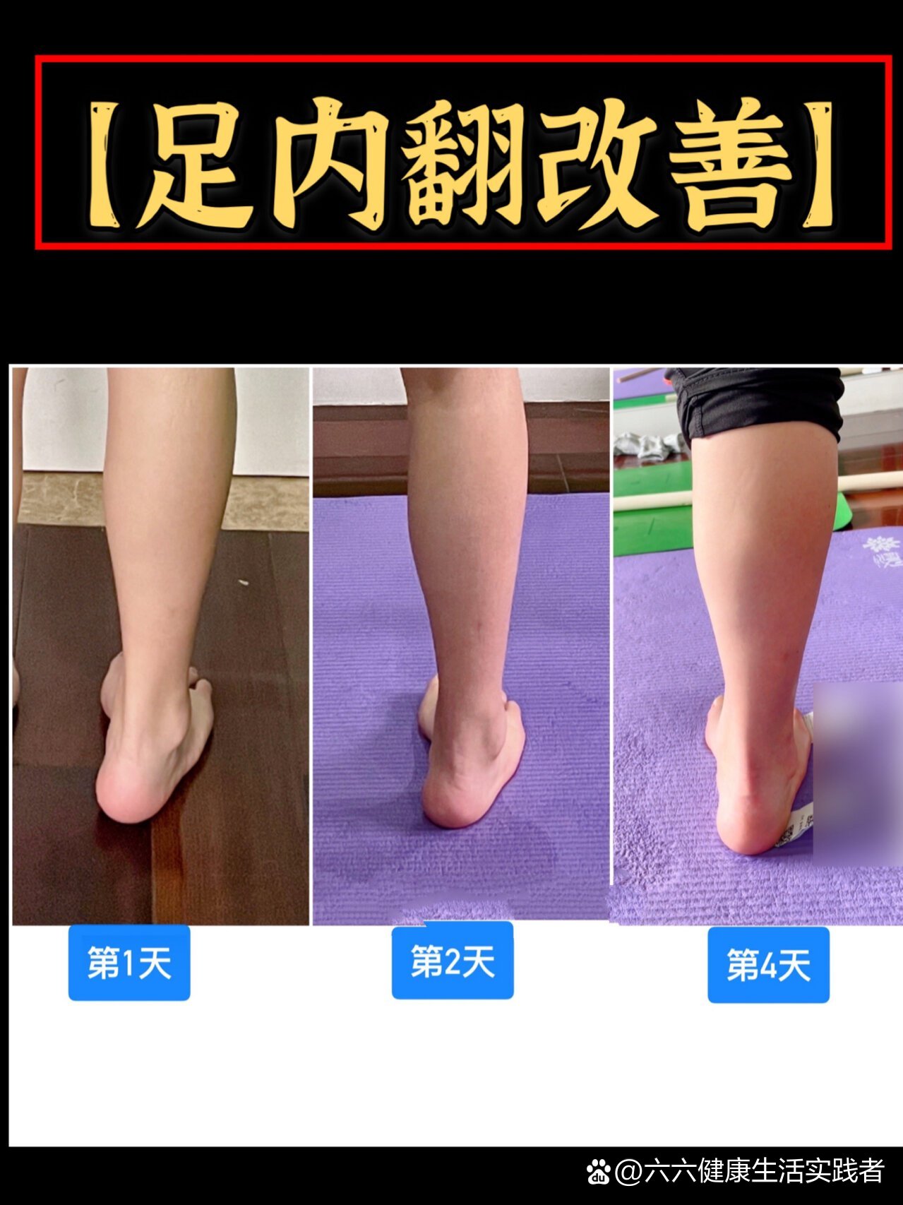 线下案例:足内翻改善