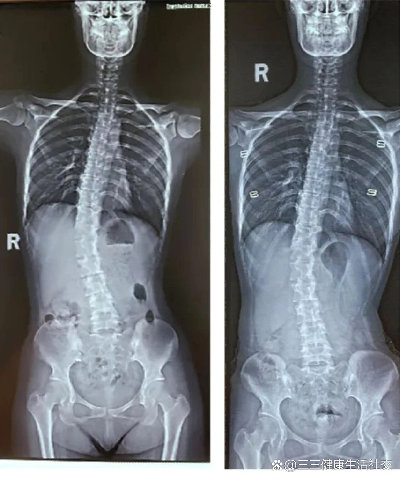 是指胸椎单节段或多节段向侧方弯曲,伴有椎体旋转的脊柱畸形