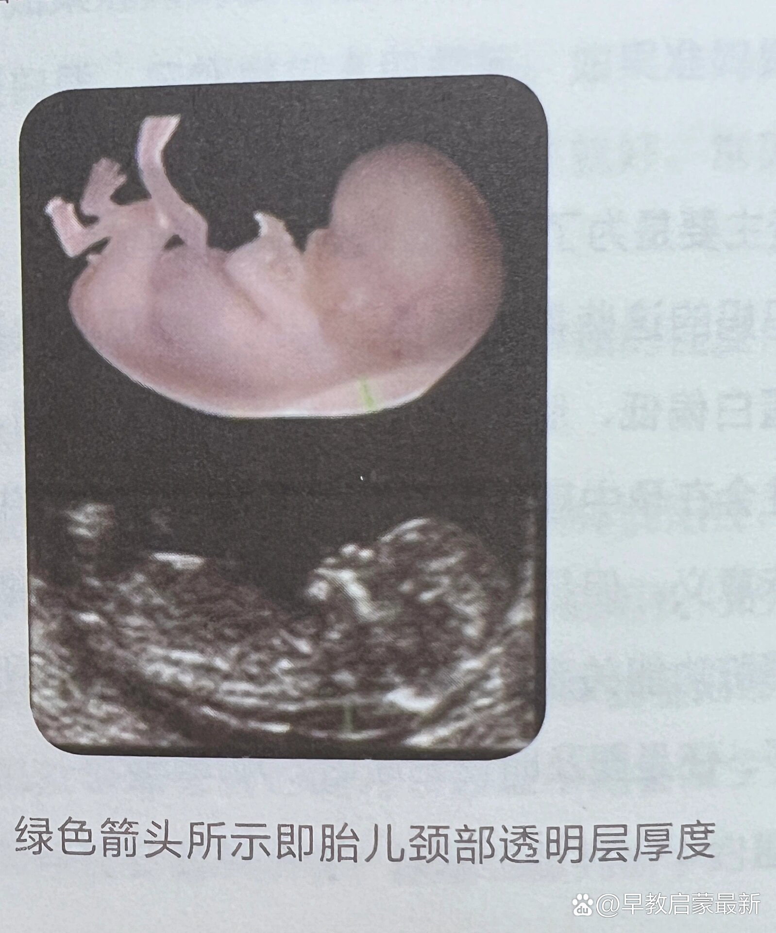 超声单提示nt 增厚请就诊产前咨询门诊这是不是说明胎儿有问题呢?