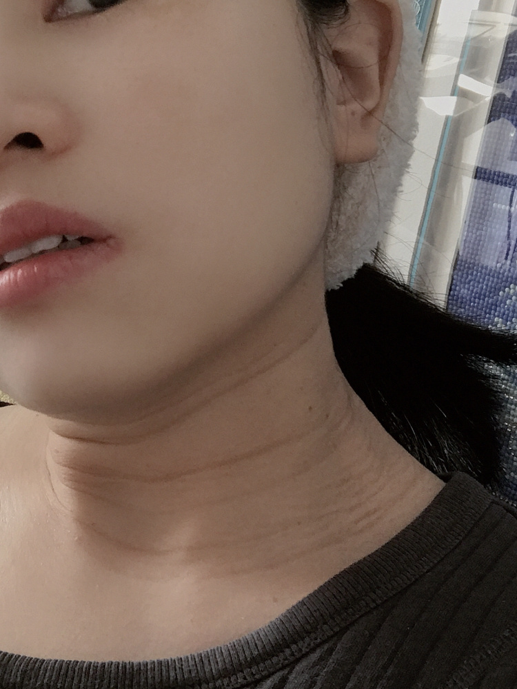 孕期长斑脖子变黑长颈纹