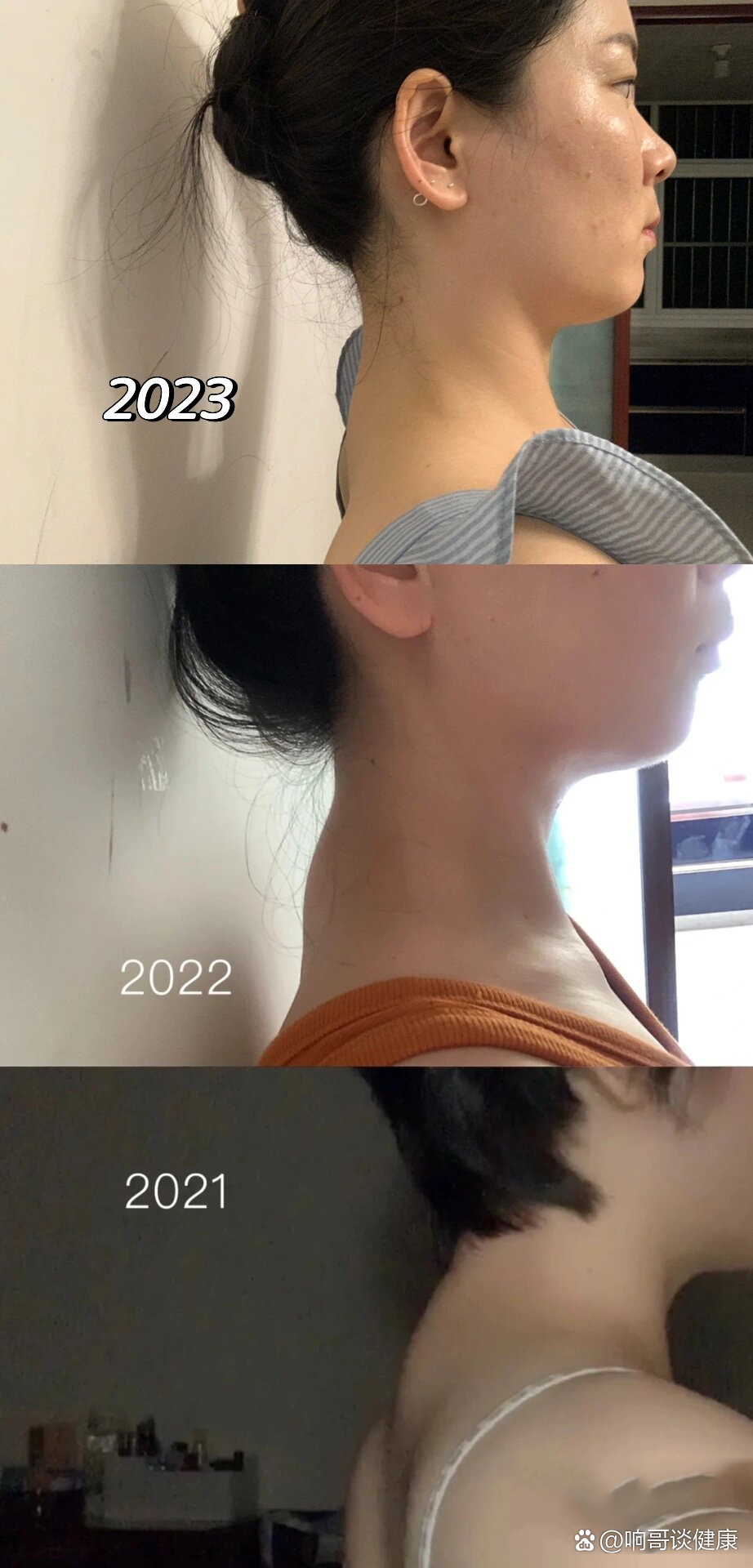 骨性富贵包,三年对比图,来看看吧