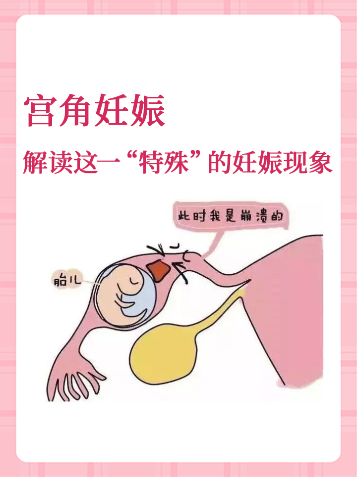 子宫角怀孕图片