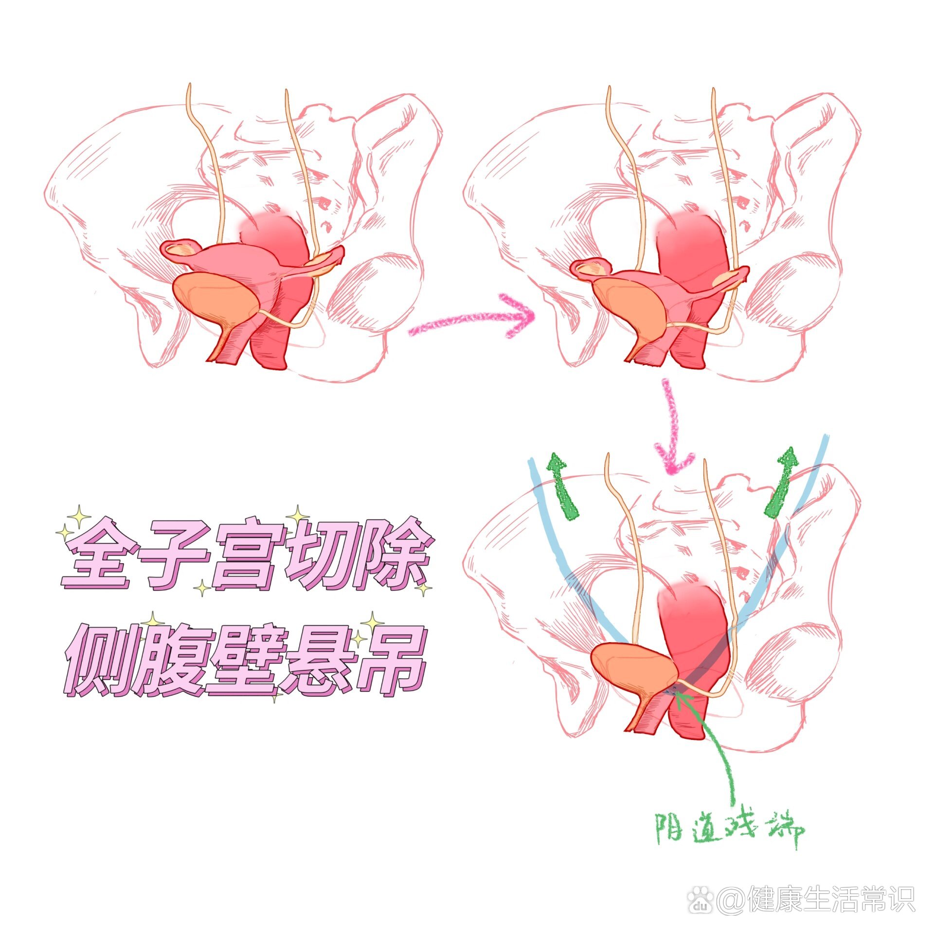 子宫脱垂-侧腹壁悬吊术