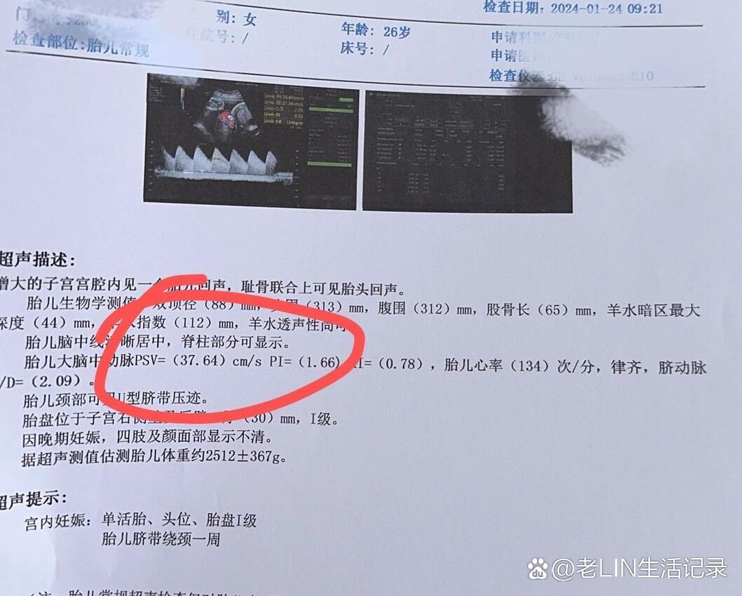 胎儿大脑中动脉psv
